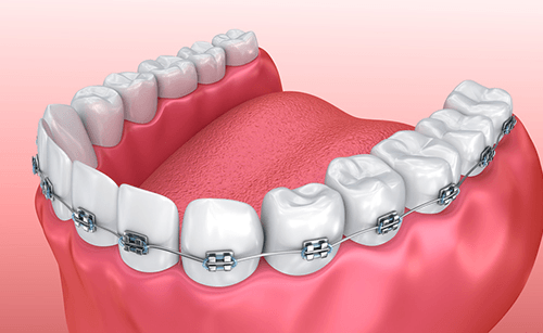 braces-480w